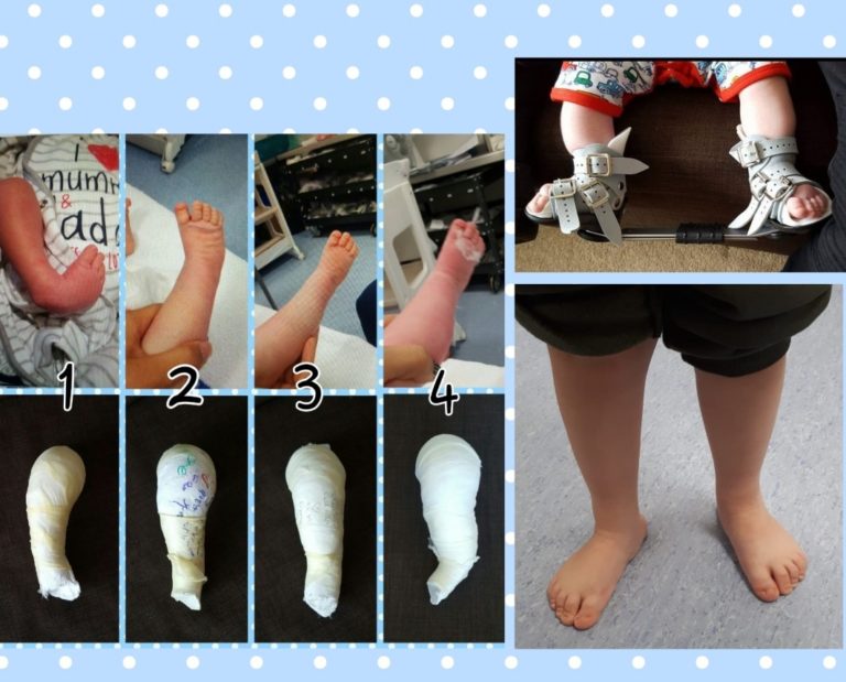 Clubfoot Maidstone And Tunbridge Wells NHS Trust